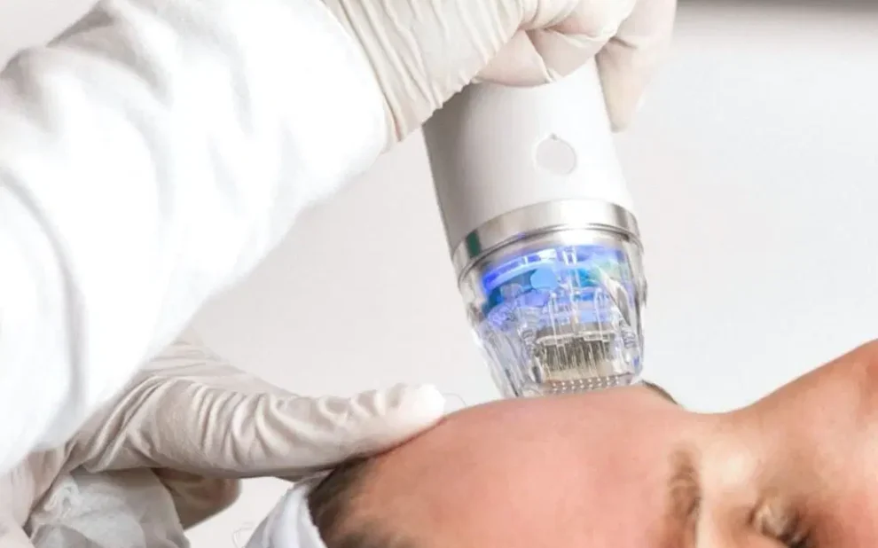 Radiofrecuencia fraccionada con micro agujas Presentamos nuestro innovador servicio de Radiofrecuencia Fraccionada con Microagujas en la Clínica del Dr. Juan Mendieta