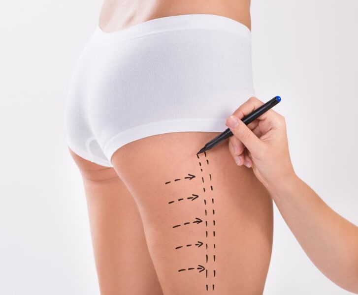 Liposucción localizada Liposucción localizada de mentón, brazos, piernas o abdomen Elimina el exceso de grasa en áreas específicas como mentón, brazos, piernas o abdomen con liposucción localizada.