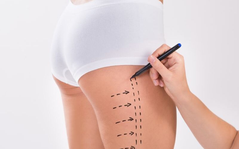 Liposucción localizada de mentón, brazos, piernas o abdomen Elimina el exceso de grasa en áreas específicas como mentón, brazos, piernas o abdomen con liposucción localizada.