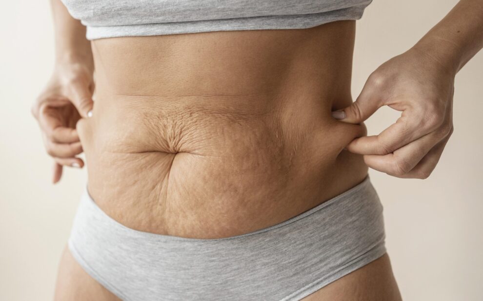 ¿Observas reducción de firmeza y flexibilidad en la piel? La Clínica del Dr. Mendieta dispone de la tecnología necesaria para restaurar la elasticidad de la piel y mejorar el tono muscular.