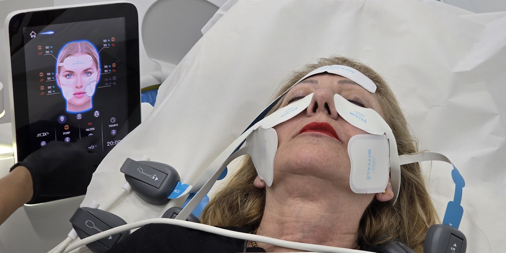 EMFACE Tratamiento para la flacidez facial EMFACE Tratamiento para la flacidez facial Se trabaja en los pómulos, en la frente y en la papada Este tratamiento es una combinación de radiofrecuencia sincronizada y tecnología HIFES™ para combatir la flacidez facial y el descolgamiento muscular del rostro. EMFACE es un innovador tratamiento diseñado para abordar la flacidez facial y el descolgamiento muscular del rostro. Es único en su clase por ser el primer procedimiento que combina radiofrecuencia sincronizada (RF) y tecnología HIFES™, sin necesidad de agujas. Esta doble acción permite trabajar de manera simultánea tanto en la piel como en los músculos faciales, ofreciendo una solución efectiva y cómoda para rejuvenecer el rostro desde sus cimientos. El funcionamiento de EMFACE se centra en la mejora de la calidad muscular. A través de contracciones selectivas de los músculos y el aumento de la densidad y calidad de la estructura muscular, este tratamiento restaura el soporte natural de los tejidos faciales. Como resultado, el rostro recupera firmeza y elevación, devolviendo una apariencia rejuvenecida y redefinida, al tiempo que mejora la estructura subyacente de manera segura y no invasiva.