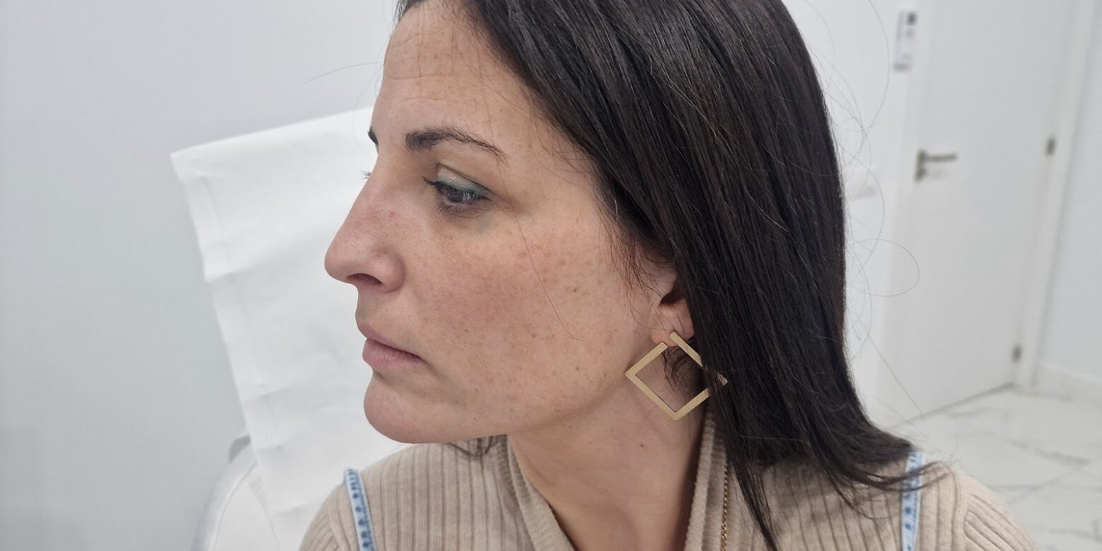 Transformaciones Sutiles y Naturales con Nuestra Última Rinomodelación Un procedimiento preciso, seguro y personalizado para realzar tu confianza En la Clínica Dr. Juan Mendieta, recientemente hemos logrado otra transformación exitosa gracias a nuestra última rinomodelación.