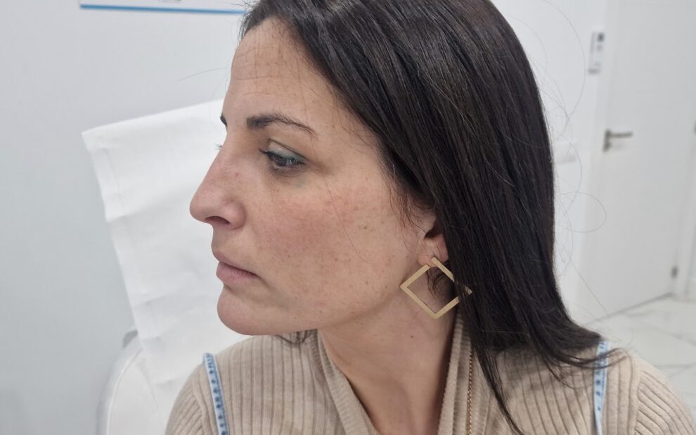 Transformaciones Sutiles y Naturales con Nuestra Última Rinomodelación Un procedimiento preciso, seguro y personalizado para realzar tu confianza En la Clínica Dr. Juan Mendieta, recientemente hemos logrado otra transformación exitosa gracias a nuestra última rinomodelación.