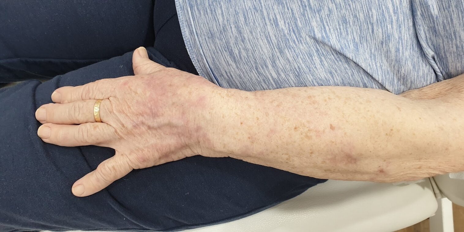 Recupera la juventud de tu piel con el Dr. Mendieta En la Clínica Dr. Juan Mendieta, entendemos cómo las manchas en manos y brazos pueden afectar tu confianza y apariencia. Por eso, ofrecemos tratamientos avanzados de eliminación de manchas diseñados para recuperar la luminosidad y juventud de tu piel.