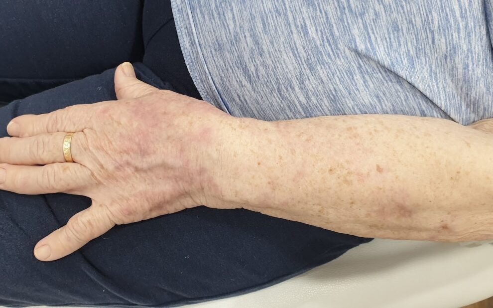 Recupera la juventud de tu piel con el Dr. Mendieta En la Clínica Dr. Juan Mendieta, entendemos cómo las manchas en manos y brazos pueden afectar tu confianza y apariencia. Por eso, ofrecemos tratamientos avanzados de eliminación de manchas diseñados para recuperar la luminosidad y juventud de tu piel.