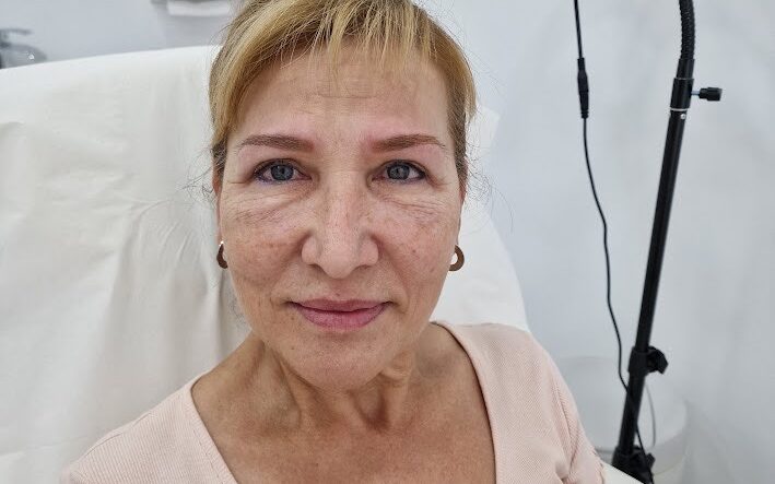Transforma tu mirada con nuestra micropigmentación Un antes y después que ilumina tu rostro En la Clínica Dr. Juan Mendieta, somos expertos en resaltar tu belleza natural, y nuestra última micropigmentación de cejas es prueba de ello.