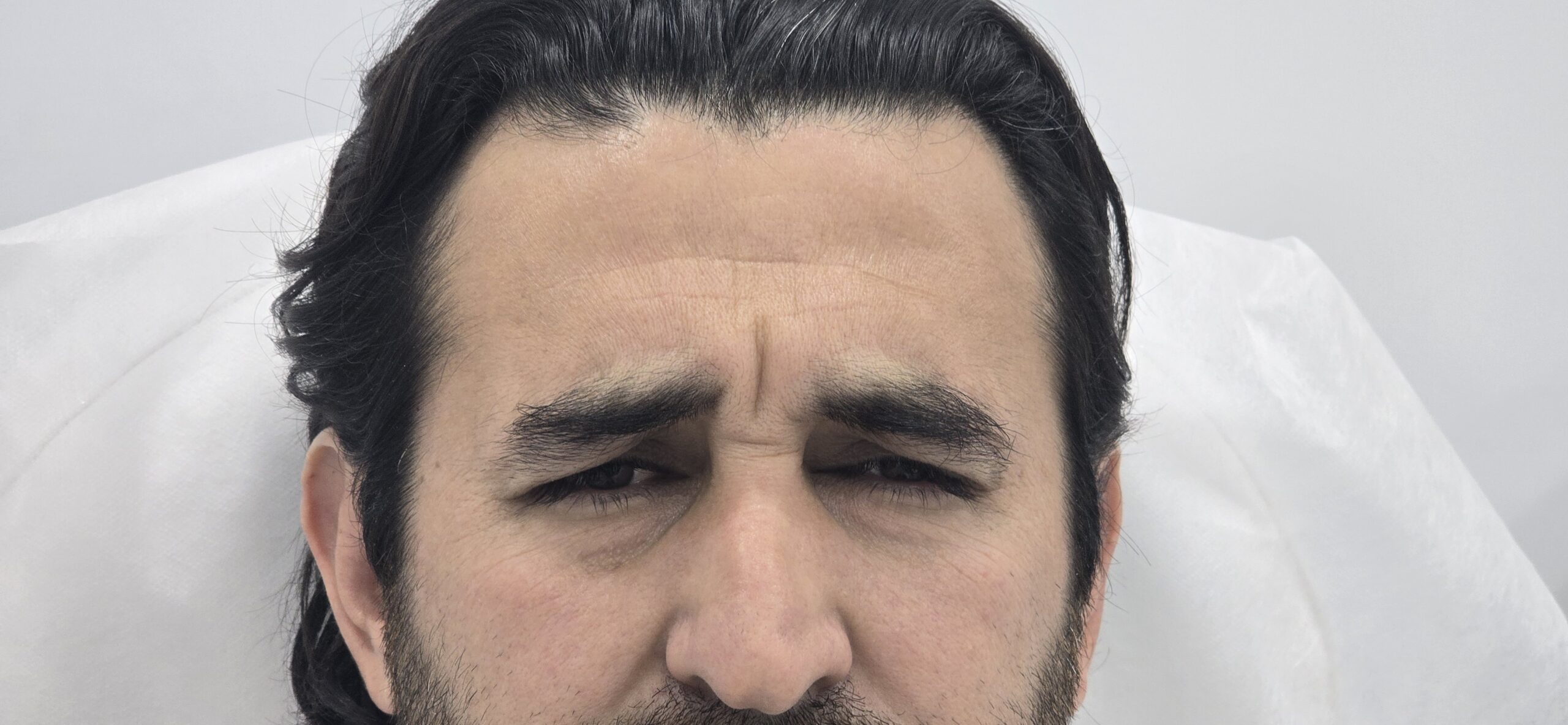 Los neuromoduladores en estética son tratamientos mínimamente invasivos que actúan relajando temporalmente los músculos responsables de las líneas de expresión y arrugas en el rostro.
