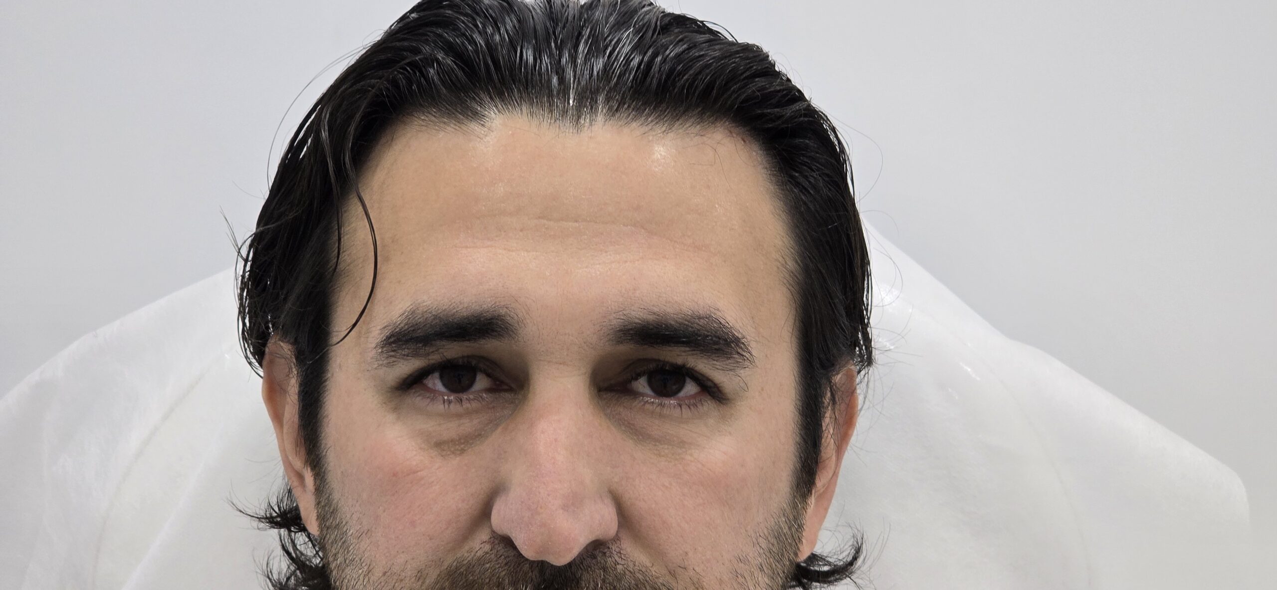 Los neuromoduladores en estética son tratamientos mínimamente invasivos que actúan relajando temporalmente los músculos responsables de las líneas de expresión y arrugas en el rostro.