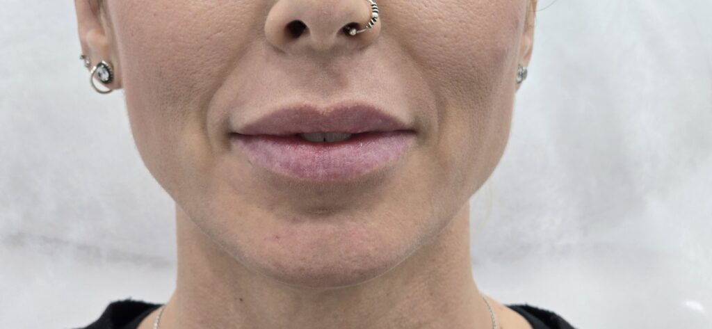 En Clínica Dr. Juan Mendieta, nos especializamos en tratamientos estéticos adaptados a las necesidades individuales de cada paciente. Un caso que refleja nuestra dedicación es el de una paciente que deseaba aumentar el volumen de sus labios de manera sutil y natural.