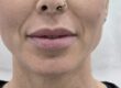 En Clínica Dr. Juan Mendieta, nos especializamos en tratamientos estéticos adaptados a las necesidades individuales de cada paciente. Un caso que refleja nuestra dedicación es el de una paciente que deseaba aumentar el volumen de sus labios de manera sutil y natural.