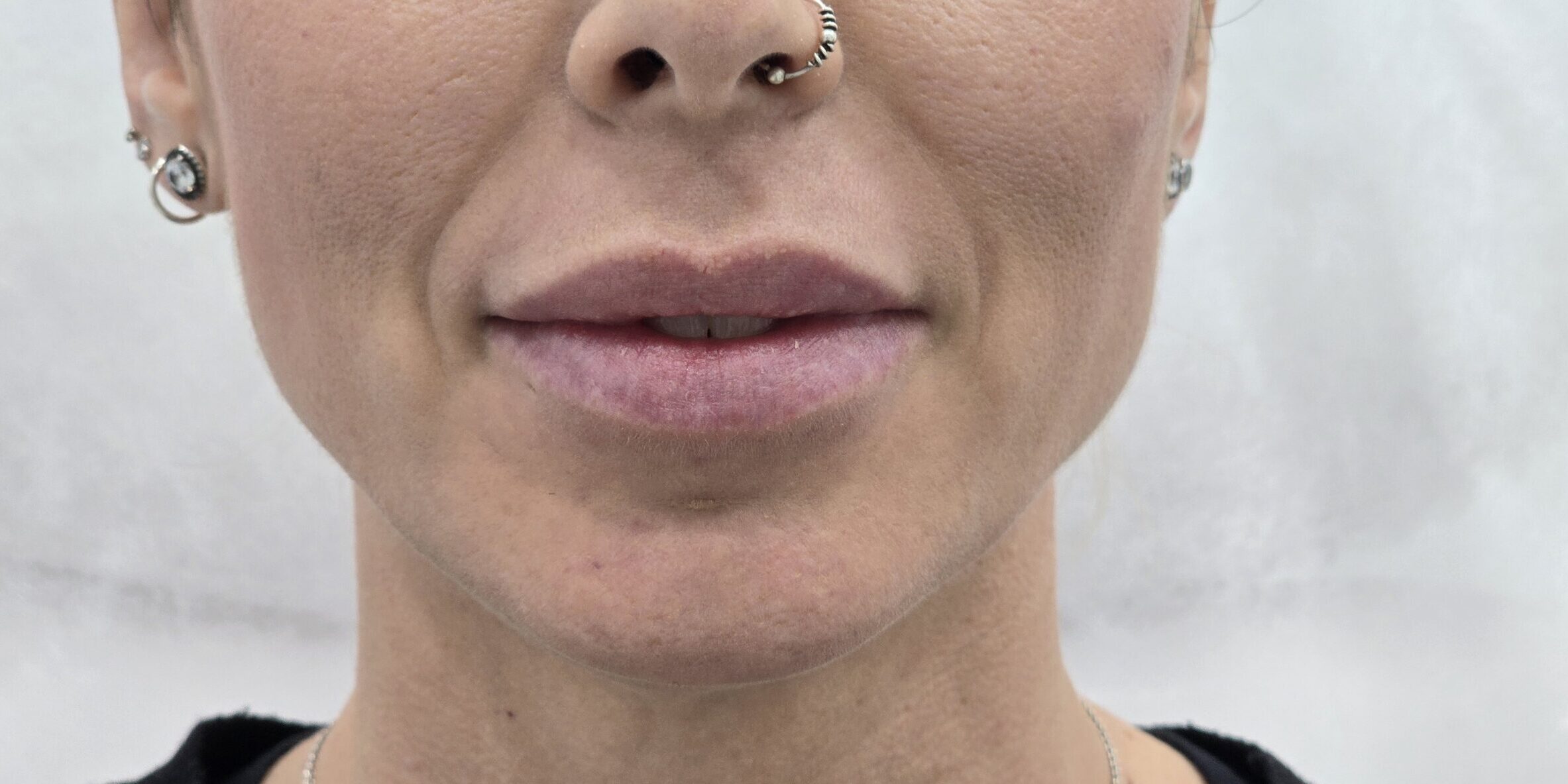 Transformación natural con ácido hialurónico en Clínica Dr. Juan Mendieta Una experiencia personalizada que resalta tu belleza natural En Clínica Dr. Juan Mendieta, nos especializamos en tratamientos estéticos adaptados a las necesidades individuales de cada paciente. Un caso que refleja nuestra dedicación es el de una paciente que deseaba aumentar el volumen de sus labios de manera sutil y natural.