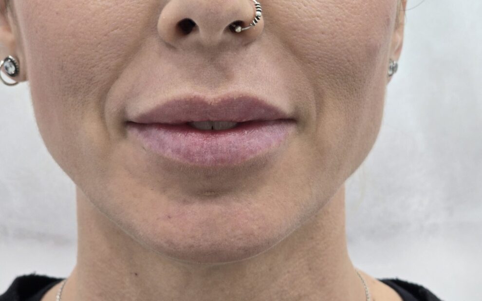 Transformación natural con ácido hialurónico en Clínica Dr. Juan Mendieta Una experiencia personalizada que resalta tu belleza natural En Clínica Dr. Juan Mendieta, nos especializamos en tratamientos estéticos adaptados a las necesidades individuales de cada paciente. Un caso que refleja nuestra dedicación es el de una paciente que deseaba aumentar el volumen de sus labios de manera sutil y natural.