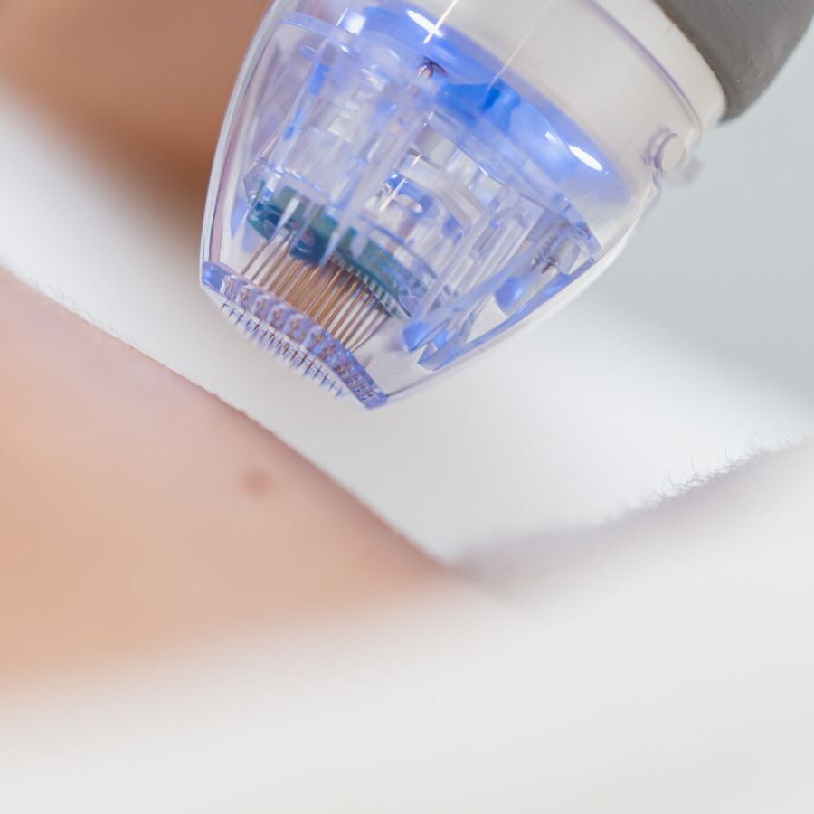 Radiofrecuencia corporal con microagujas En Clínica Dr. Juan Mendieta, presentamos la radiofrecuencia fraccionada con microagujas, una solución avanzada y efectiva para quienes buscan rejuvenecer su piel y mejorar su firmeza sin recurrir a procedimientos quirúrgicos.