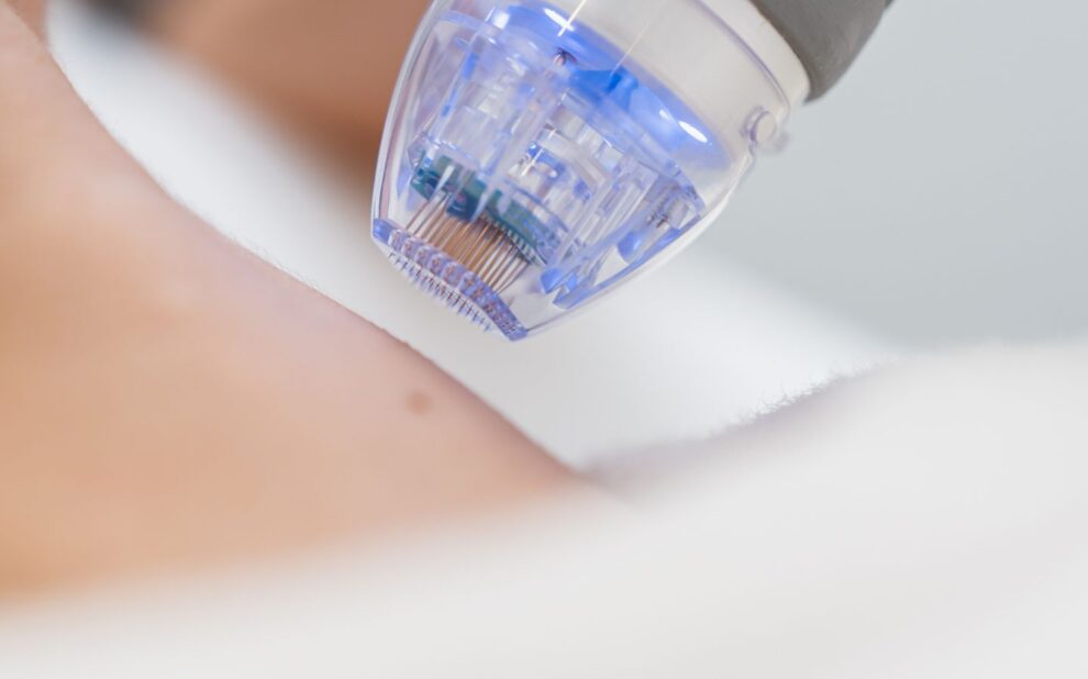 Radiofrecuencia corporal con microagujas En Clínica Dr. Juan Mendieta, presentamos la radiofrecuencia fraccionada con microagujas, una solución avanzada y efectiva para quienes buscan rejuvenecer su piel y mejorar su firmeza sin recurrir a procedimientos quirúrgicos.